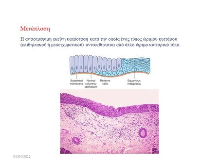 Μετάπλαση Η αντιστρέψιμη εκείνη κατάσταση κατά την οποία ένας τύπος ώριμου κυττάρου (επιθηλιακού ή μεσεγχυματικού) αντικαθίσταται από άλλο ώριμο κυτταρικό.