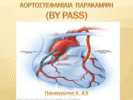 Η αορτοστεφανιαία παράκαμψη ή μπαϊ πας (bypass) είναι μια επέμβαση, η οποία βοηθάει στη βελτίωση της ροής του αίματος στις στεφανιαίες αρτηρίες της.