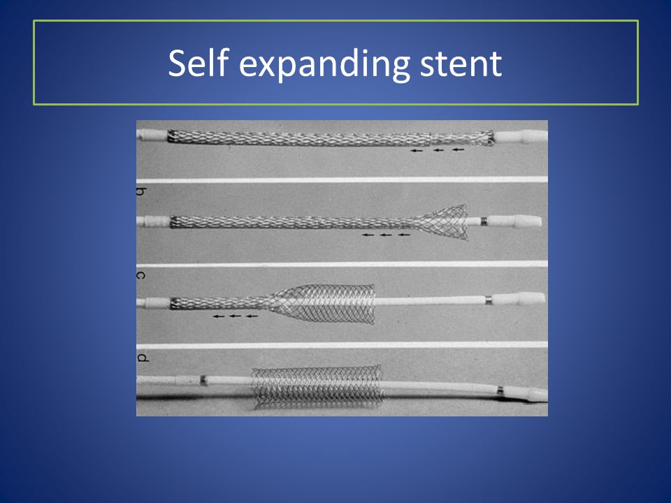 Self expanding stent