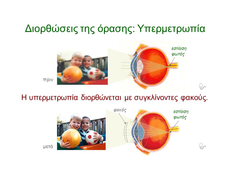 Διορθώσεις της όρασης: Υπερμετρωπία