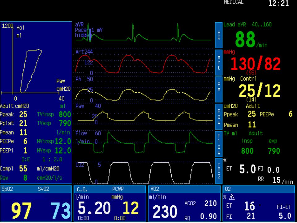 Datex-Ohmeda Critical Care Monitor is the first monitor providing the integrated hemodynamic, gas exchange and ventilation information on a single screen.