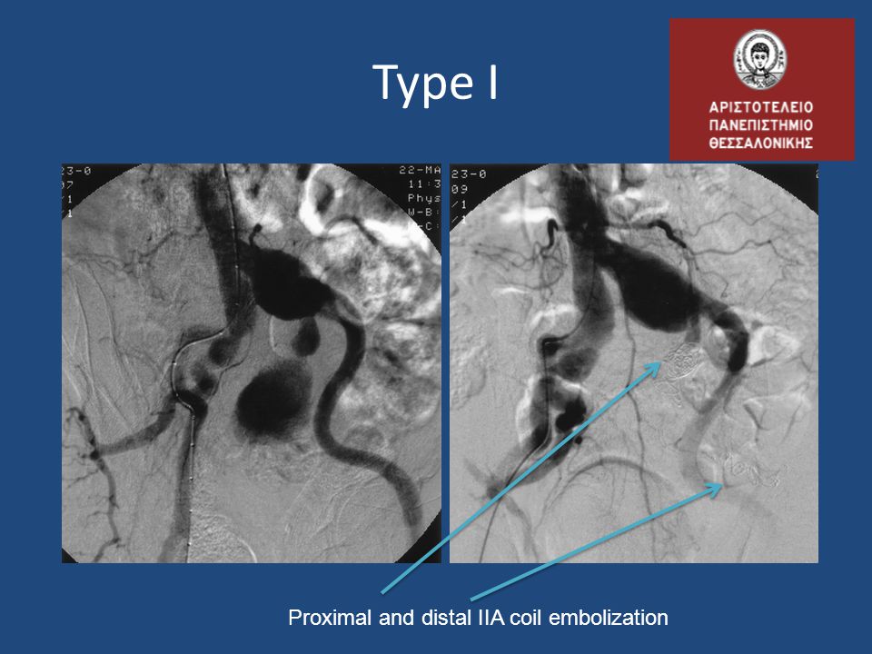Type I Proximal and distal IIA coil embolization