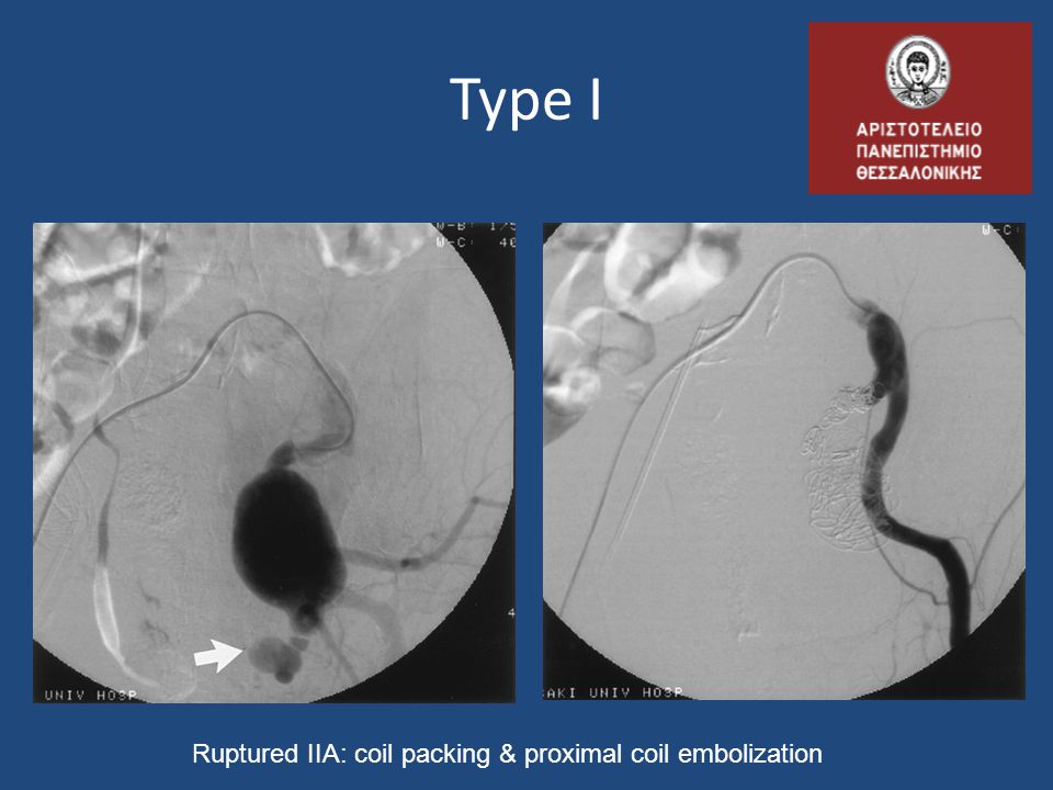 Type I Ruptured IIA: coil packing & proximal coil embolization