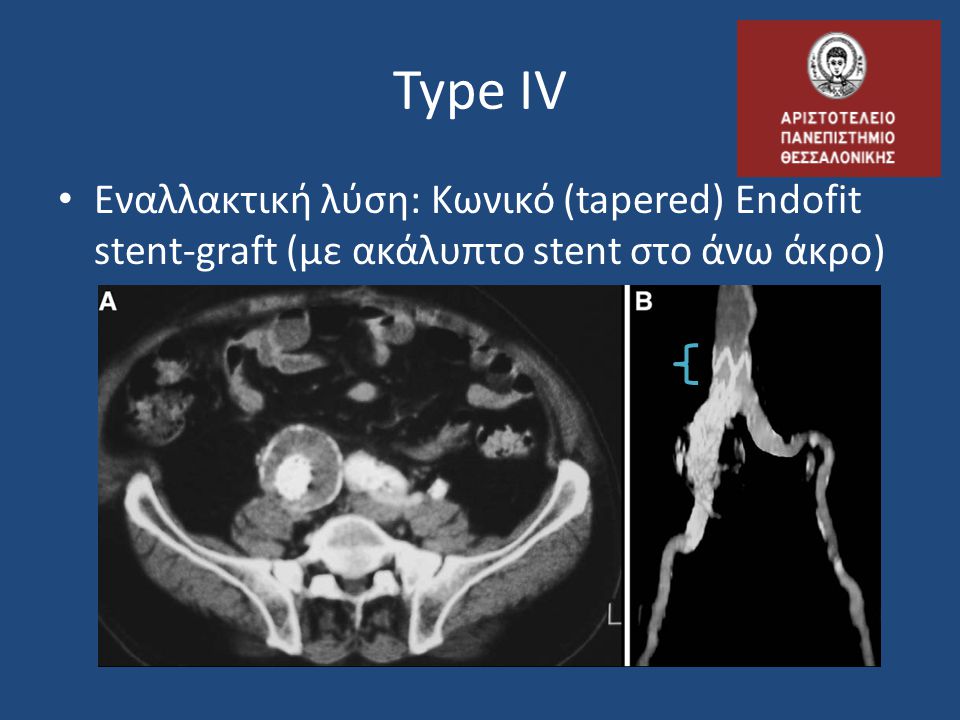 Type IV Εναλλακτική λύση: Κωνικό (tapered) Endofit stent-graft (με ακάλυπτο stent στο άνω άκρο)