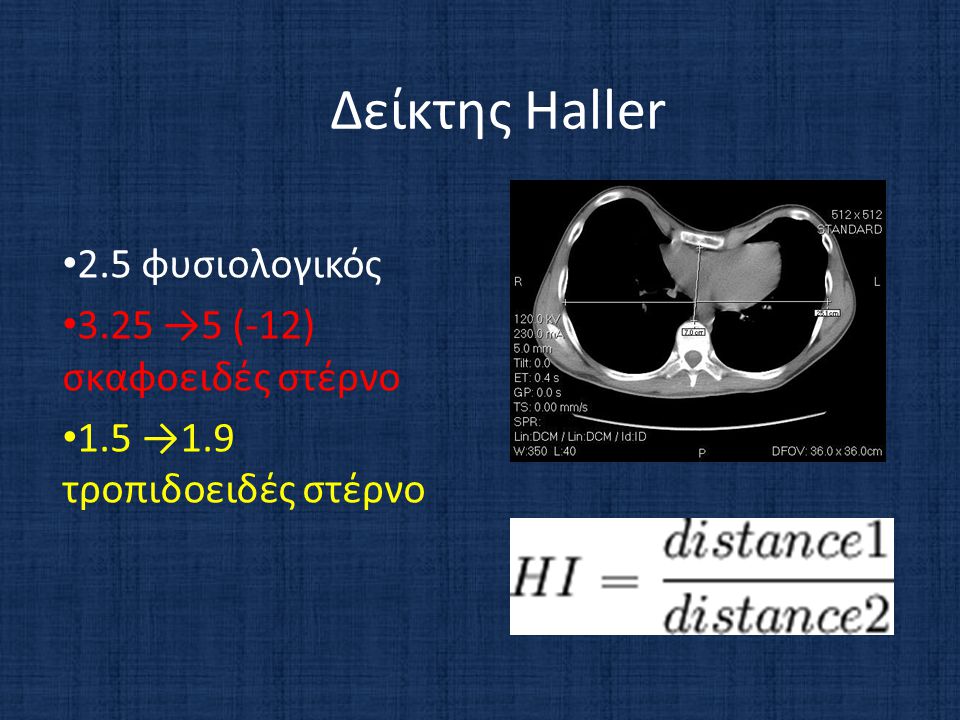 Δείκτης Haller 2.5 φυσιολογικός 3.25 →5 (-12) σκαφοειδές στέρνο