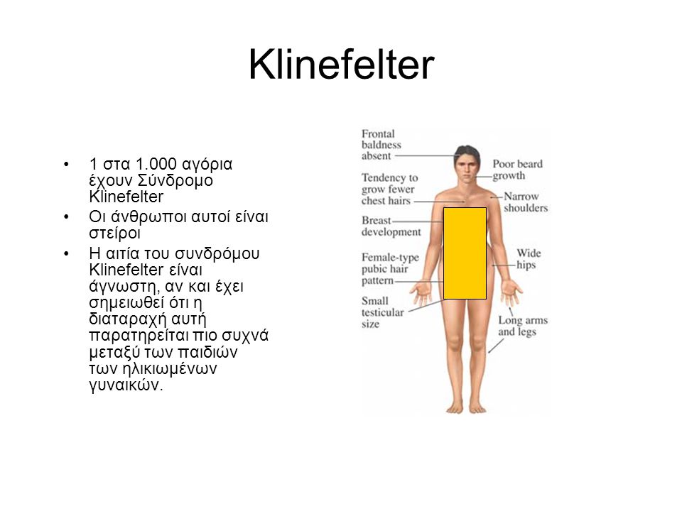 Klinefelter 1 στα αγόρια έχουν Σύνδρομο Klinefelter