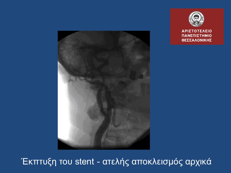 Έκπτυξη του stent - ατελής αποκλεισμός αρχικά