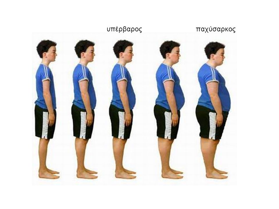υπέρβαρος παχύσαρκος