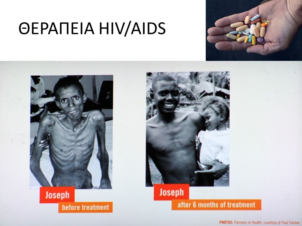 ΘΕΡΑΠΕΙΑ HIV/AIDS