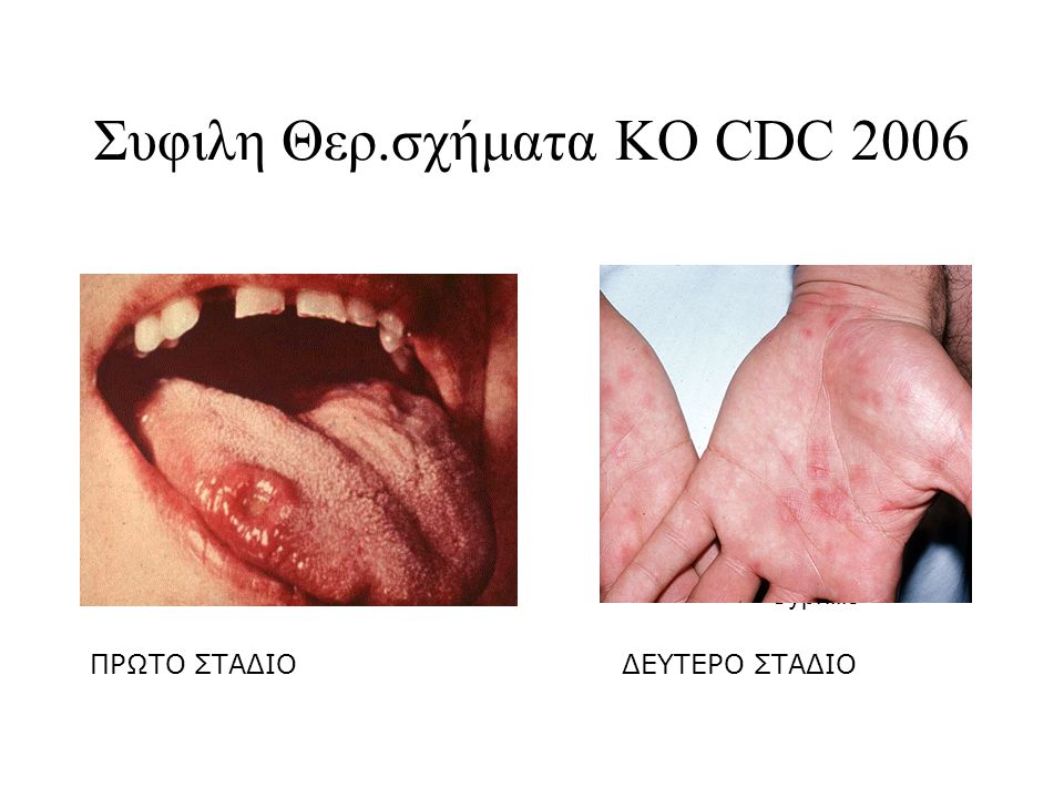 Συφιλη Θερ.σχήματα KO CDC 2006