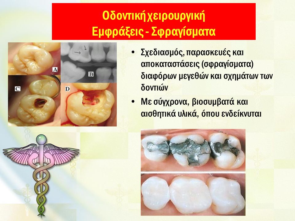 Οδοντική χειρουργική Εμφράξεις - Σφραγίσματα