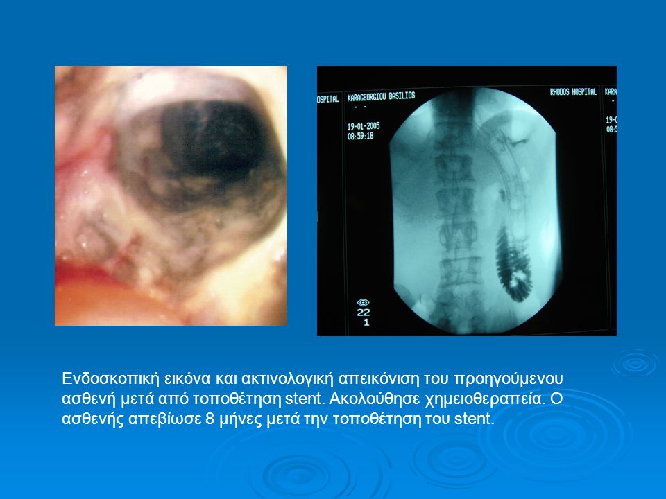 Ενδοσκοπική εικόνα και ακτινολογική απεικόνιση του προηγούμενου ασθενή μετά από τοποθέτηση stent.