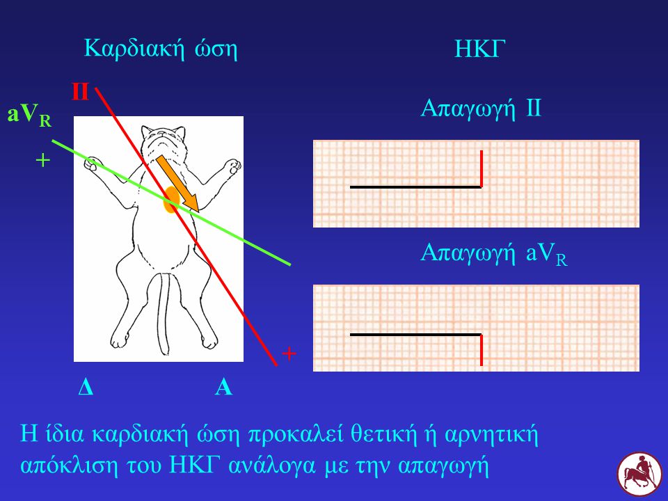 Καρδιακή ώση ΗΚΓ. II. Απαγωγή ΙΙ. aVR. + Απαγωγή aVR. + Δ. Α.