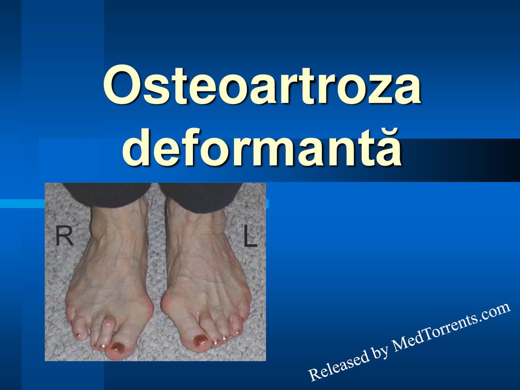 osteoartrita deformanta medicamente miotrope pentru osteochondroza cervicală