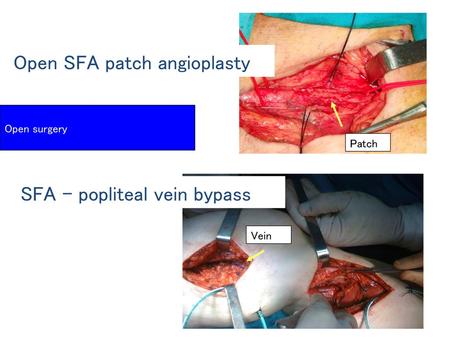 Open SFA patch angioplasty