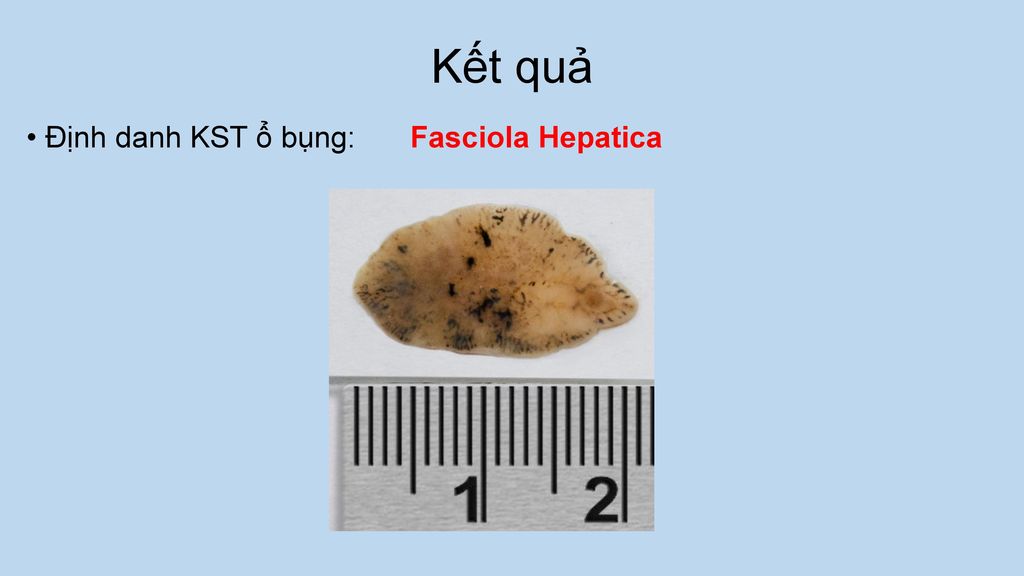 Kết quả Định danh KST ổ bụng: Fasciola Hepatica