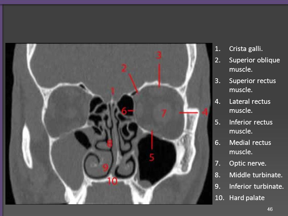 Frontal sinus. Frontal bone. Globe. Maxillary sinus. Nasal septum. Inferior turbinate.