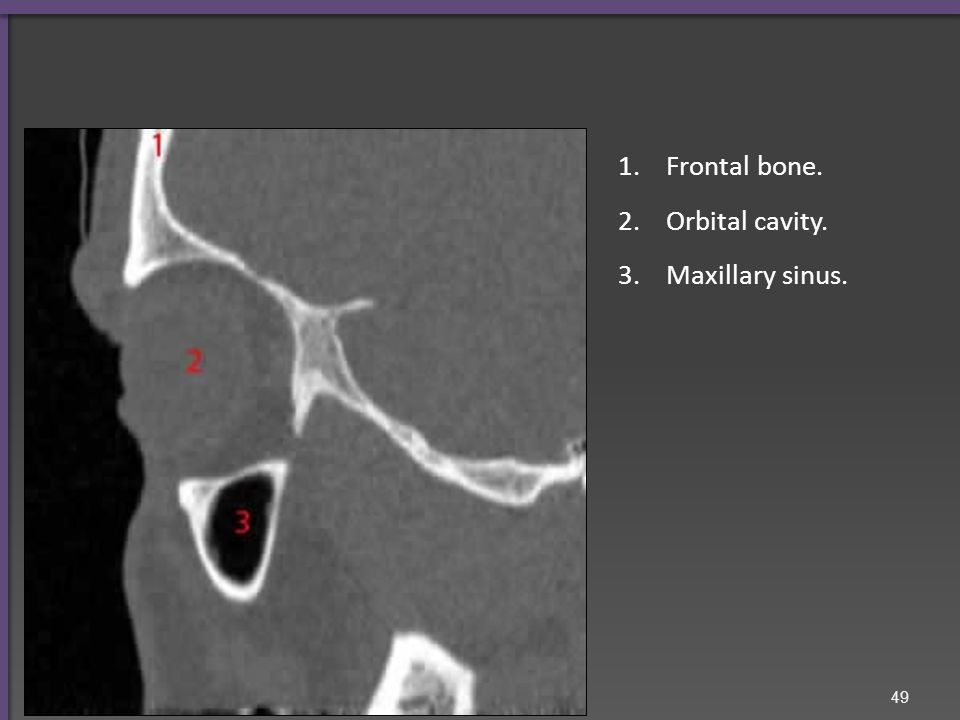 Frontal sinus. Orbital cavity. Optic nerve. Maxillary sinus. Inferior orbital fissure.