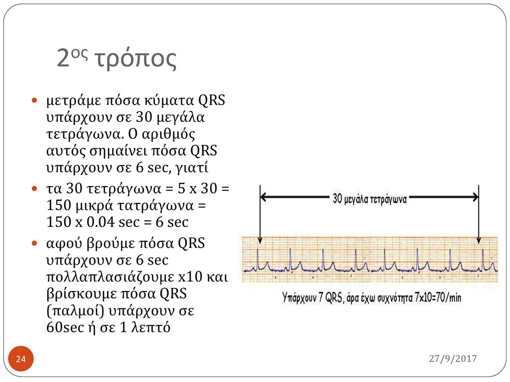 2ος τρόπος μετράμε πόσα κύματα QRS υπάρχουν σε 30 μεγάλα τετράγωνα. Ο αριθμός αυτός σημαίνει πόσα QRS υπάρχουν σε 6 sec, γιατί.