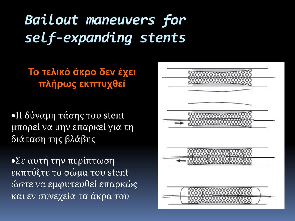 Bailout maneuvers for self-expanding stents
