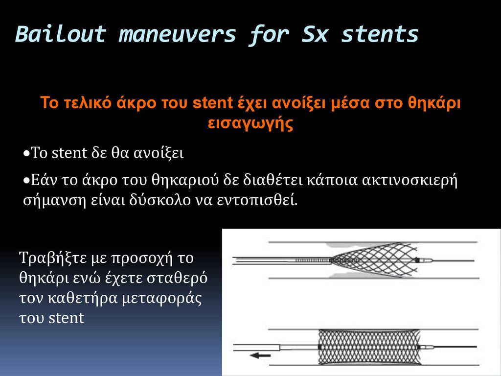Bailout maneuvers for Sx stents