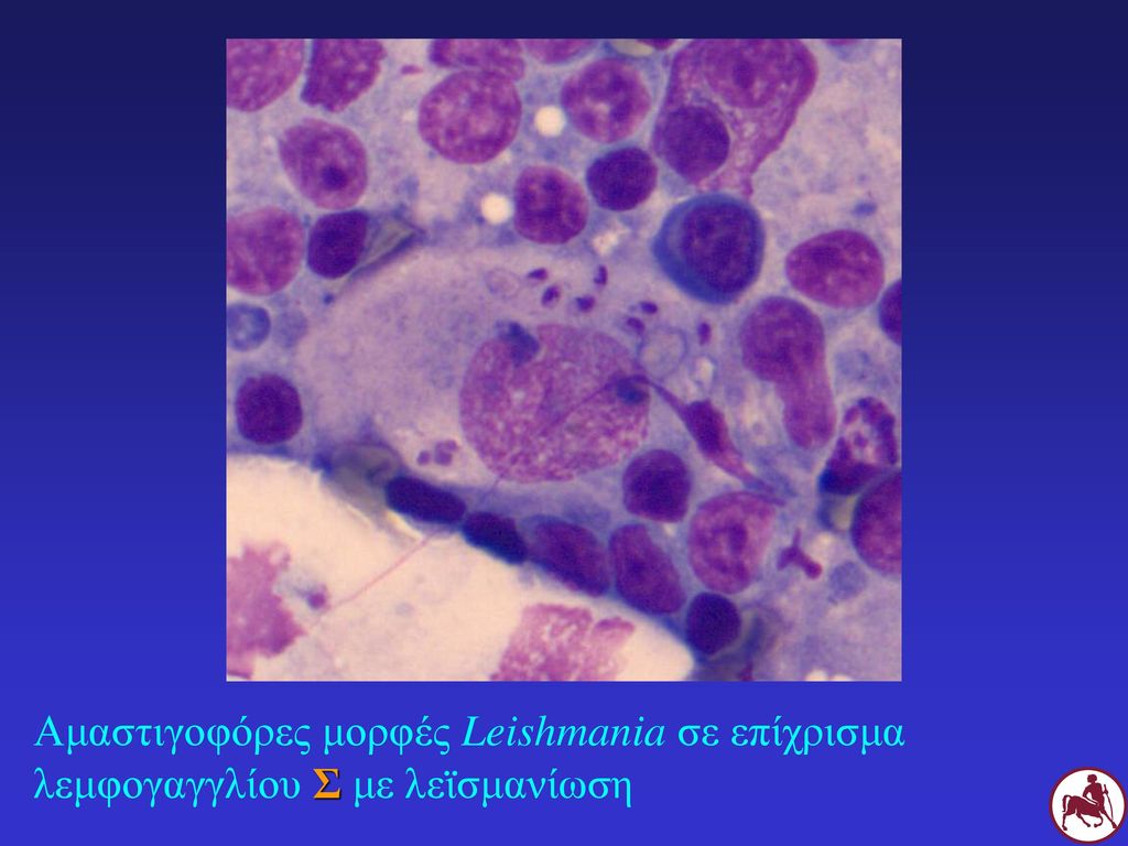 Αμαστιγοφόρες μορφές Leishmania σε επίχρισμα λεμφογαγγλίου Σ με λεϊσμανίωση