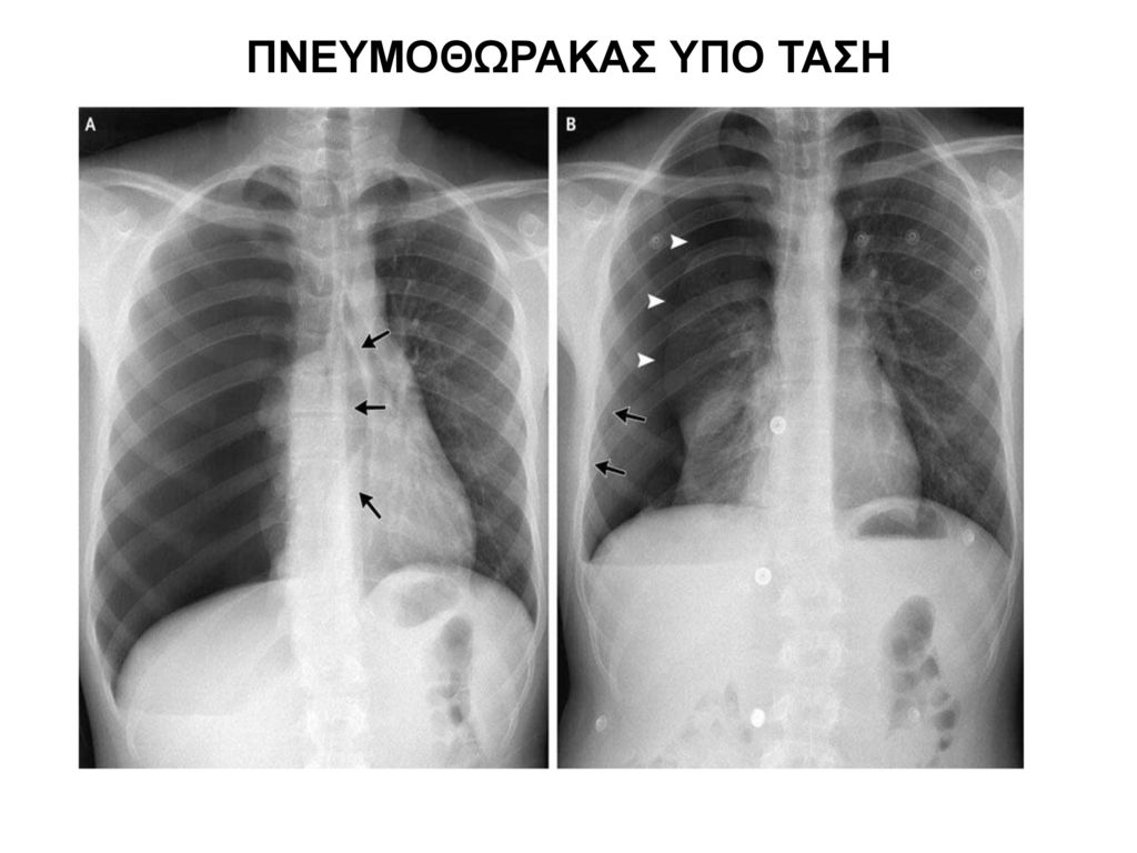 Разрыв легочной. Спонтанный пневмоторакс рентген. Пневмоторакс рентген. Рентген при пневмотораксе. Частичный пневмоторакс рентген.
