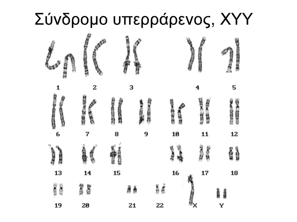 Пересадка хромосом. Синдром дисомии по y-хромосоме кариотип. Синдром полисомии y-хромосомы кариотип. Синдром полисомии по у хромосоме кариотип. Синдром Марфана кариотип.