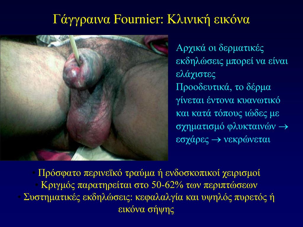 Γάγγραινα Fournier: Κλινική εικόνα