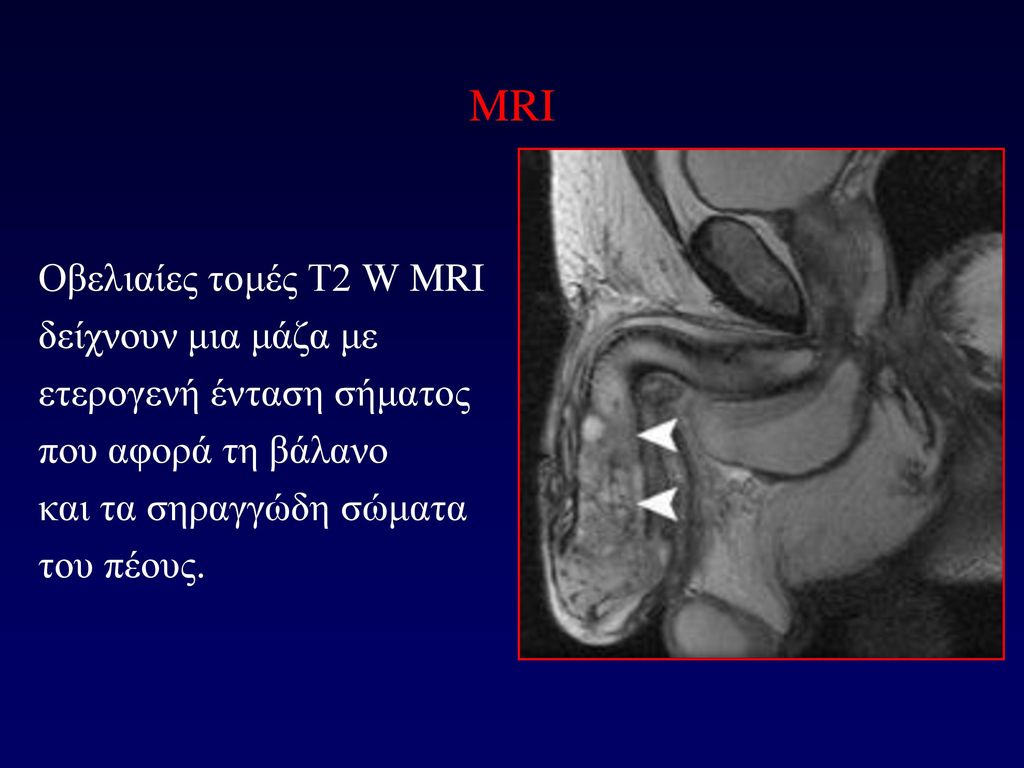 MRI Οβελιαίες τομές T2 W MRI δείχνουν μια μάζα με