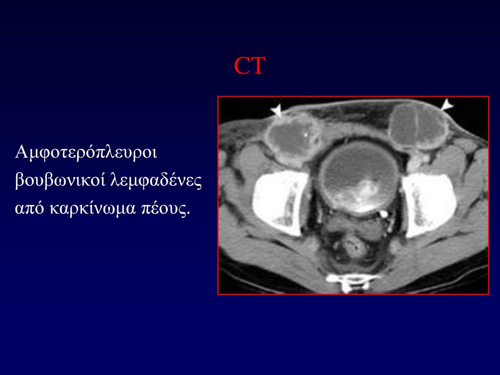 CT Αμφοτερόπλευροι βουβωνικοί λεμφαδένες από καρκίνωμα πέους.
