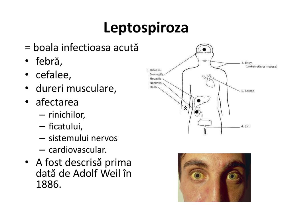 Leptospiroza = boala infectioasa acută: febră, cefalee,