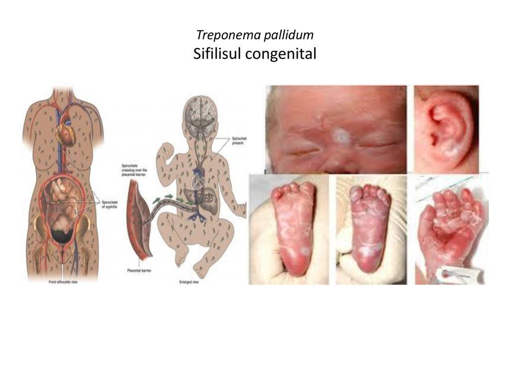 Treponema pallidum Sifilisul congenital