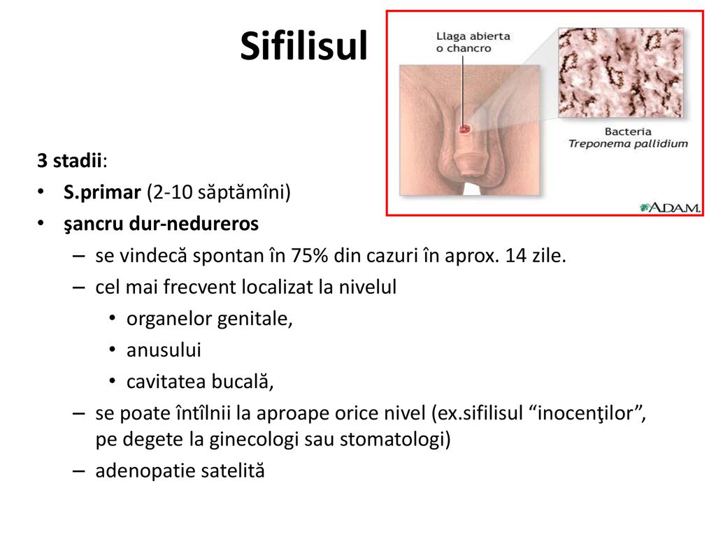 Sifilisul 3 stadii: S.primar (2-10 săptămîni) şancru dur-nedureros