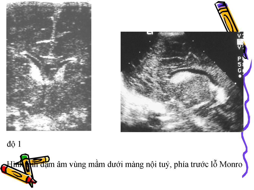 độ 1 Hình ảnh đậm âm vùng mầm dưới màng nội tuỷ, phía trước lỗ Monro