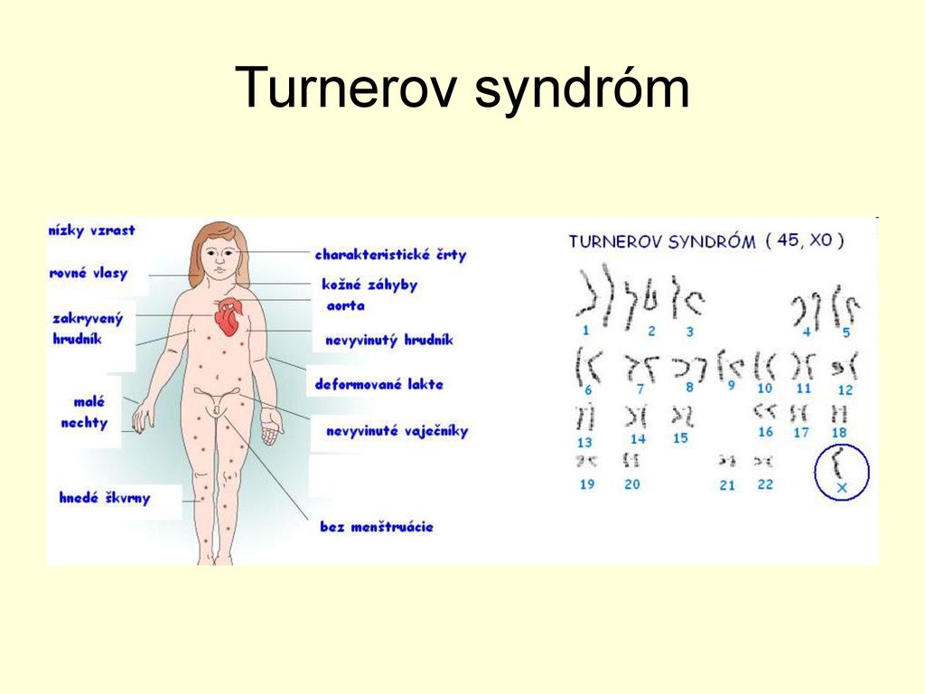 Turnerov syndróm