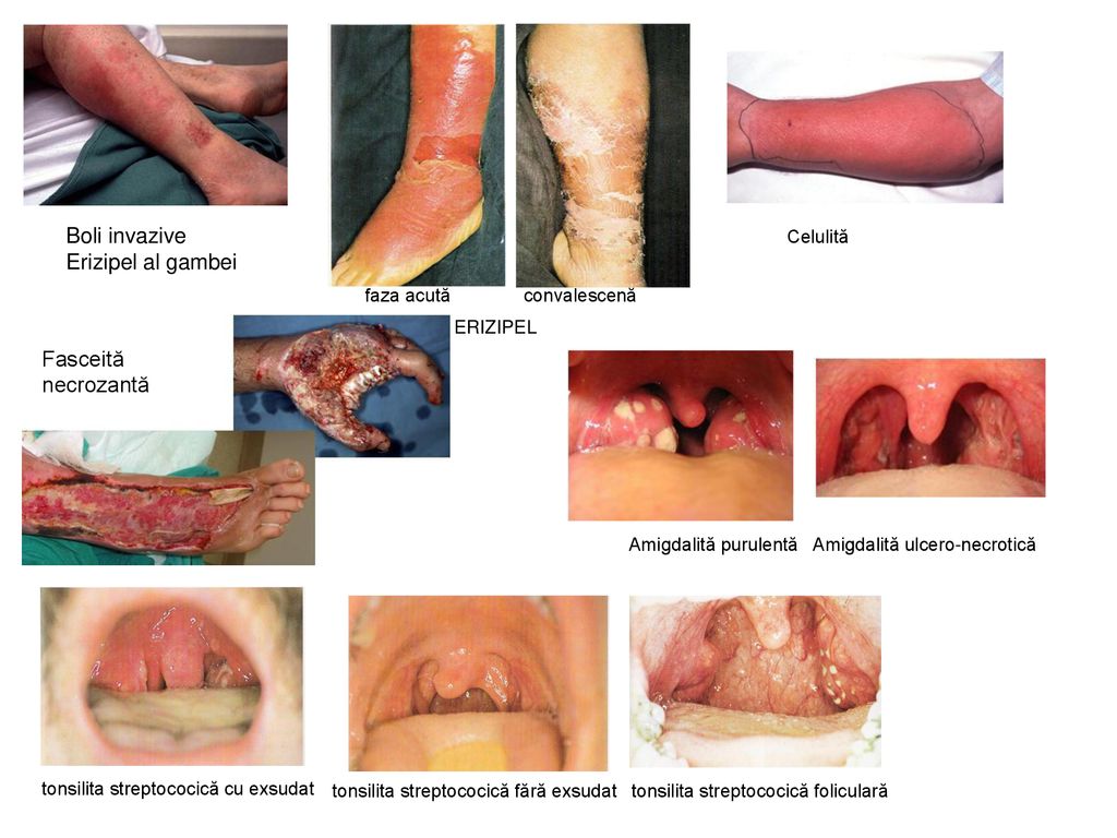 Boli invazive Erizipel al gambei Fasceită necrozantă Celulită