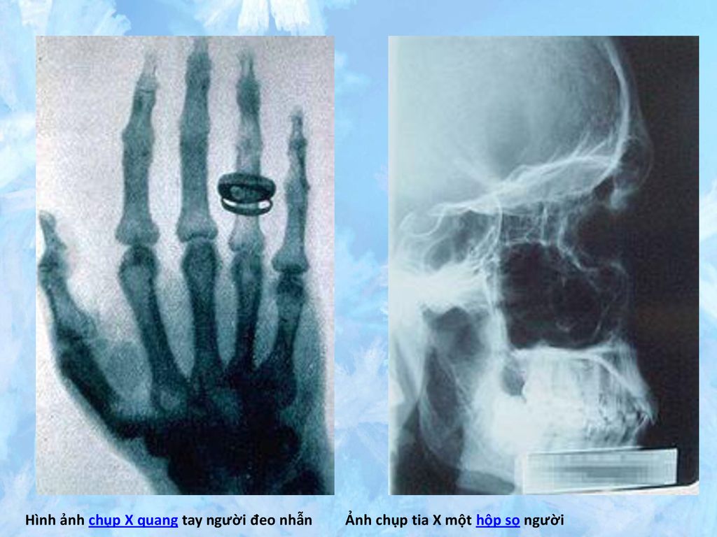 Hình ảnh chụp X quang tay người đeo nhẫn Ảnh chụp tia X một hộp sọ người
