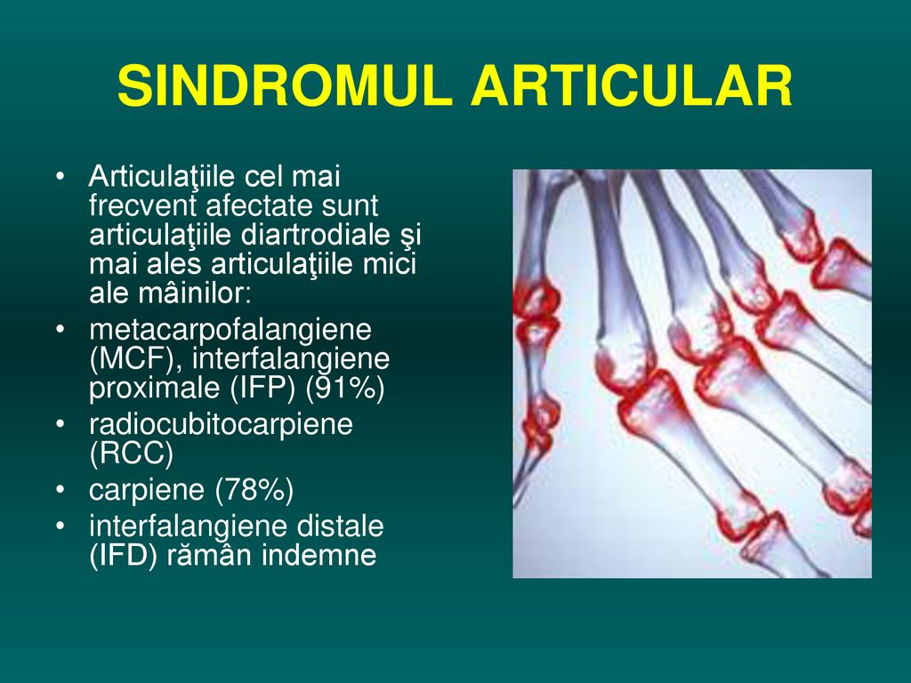 artrita artroza articulațiilor mâinilor complicații sistemice boli ale țesutului conjunctiv
