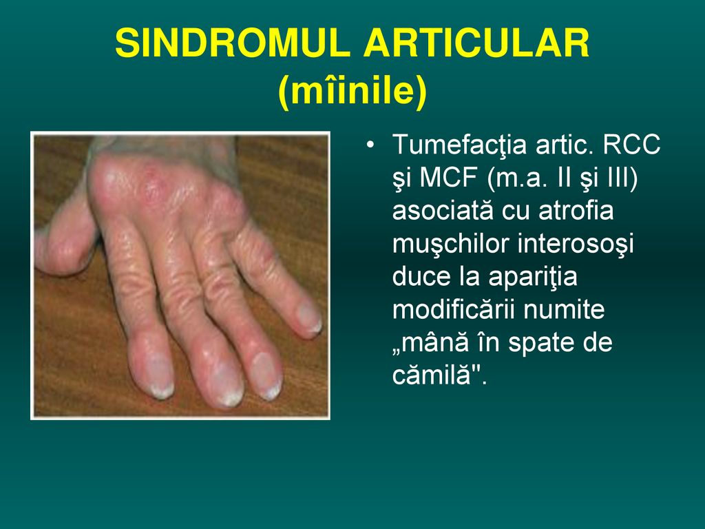 boală articulară nespecificată cum se tratează artroza artrita articulațiilor