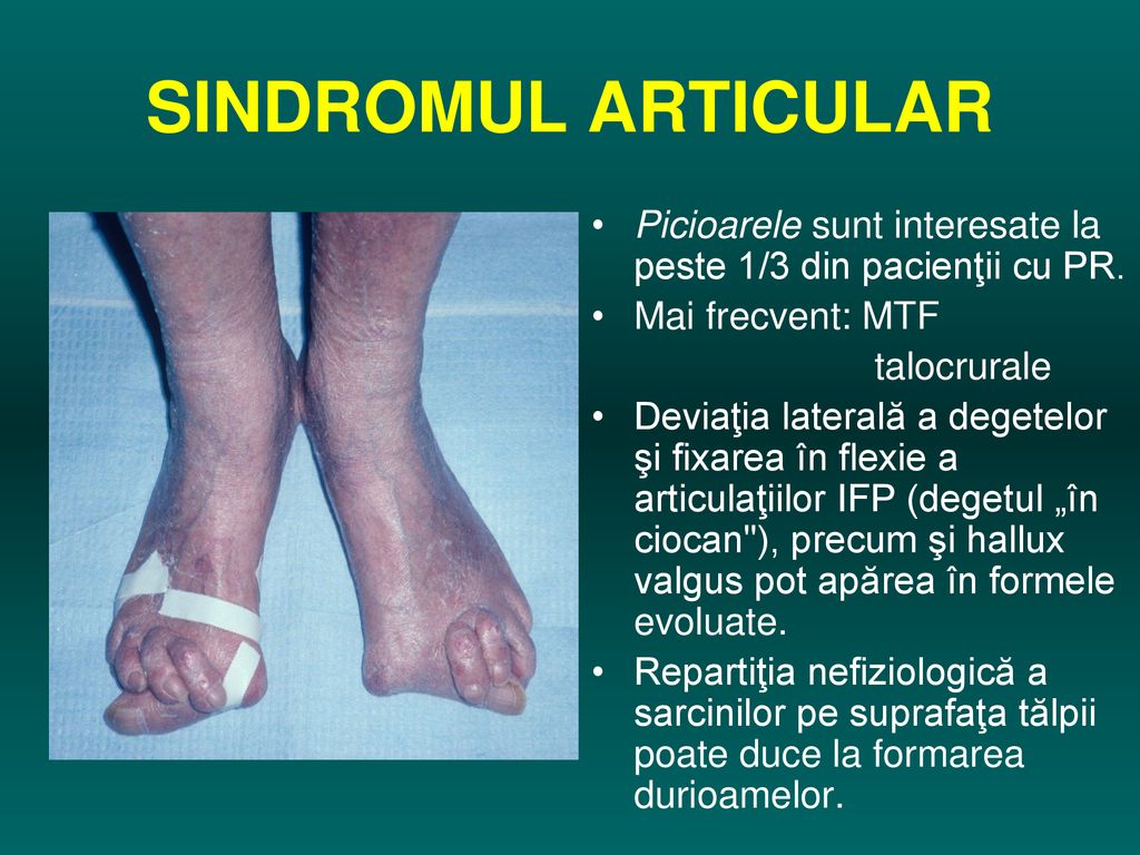 infuzie de boală articulară de ce articulațiile la genunchi doare după alergare