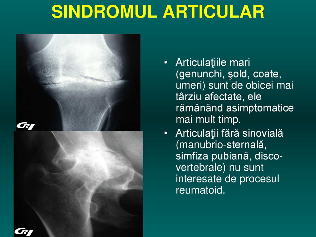 semne radiologice ale bolii articulare