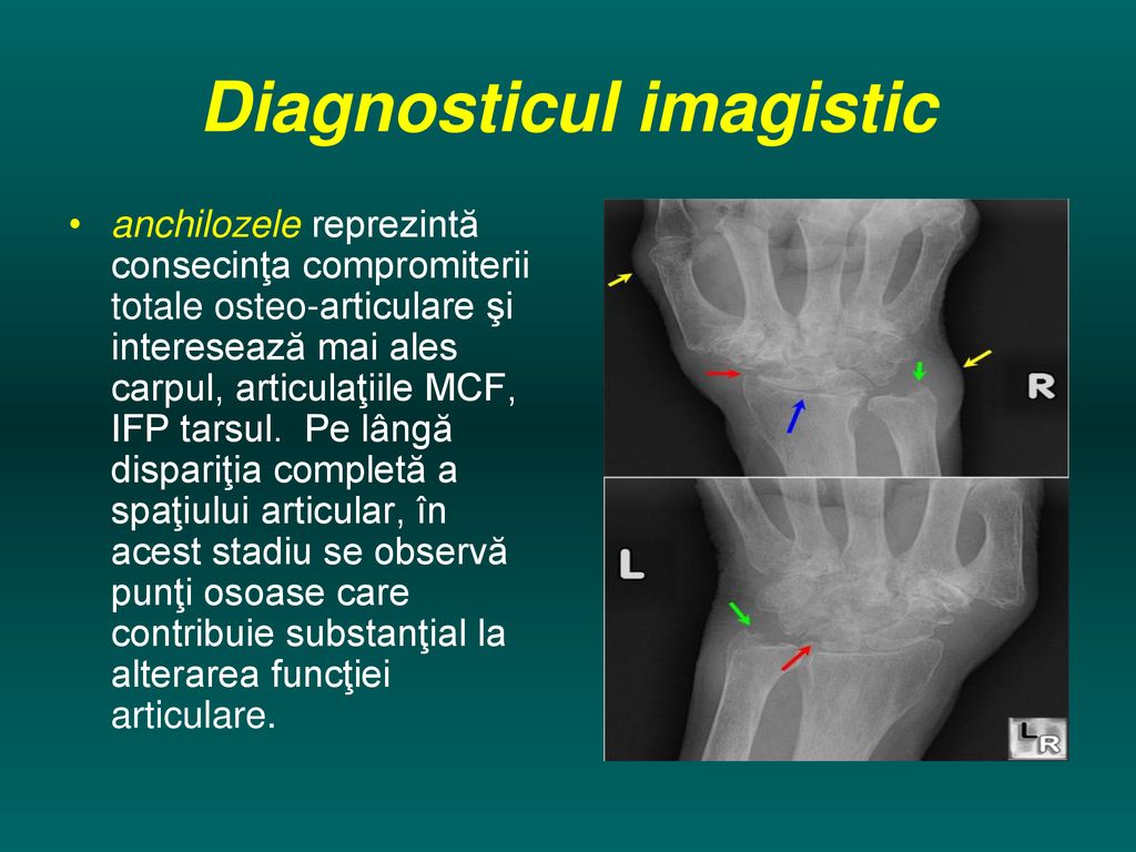 sindroame radiologice principale ale bolilor osoase și articulare de ce durerea articulațiilor șoldului după ședință prelungită