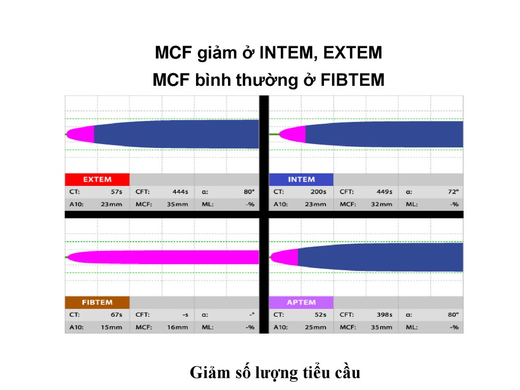 MCF bình thường ở FIBTEM