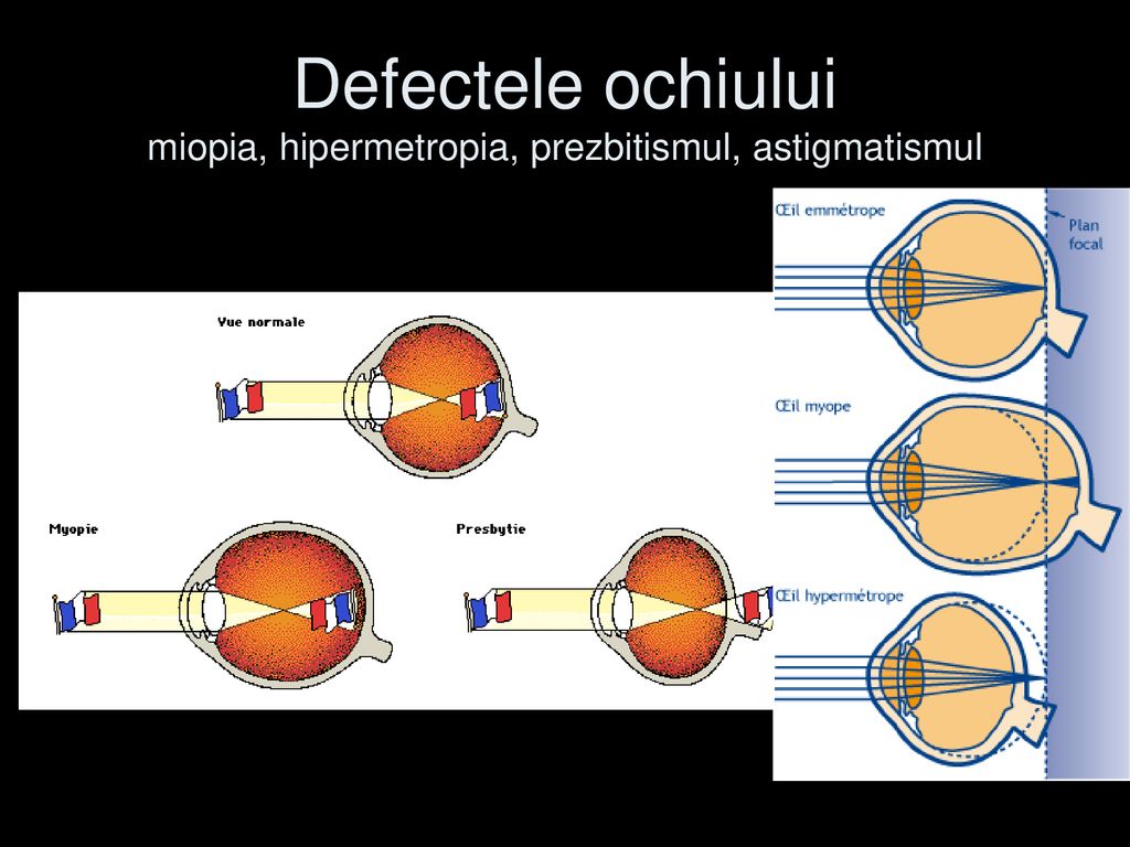 Defectele ochiului miopia, hipermetropia, prezbitismul, astigmatismul