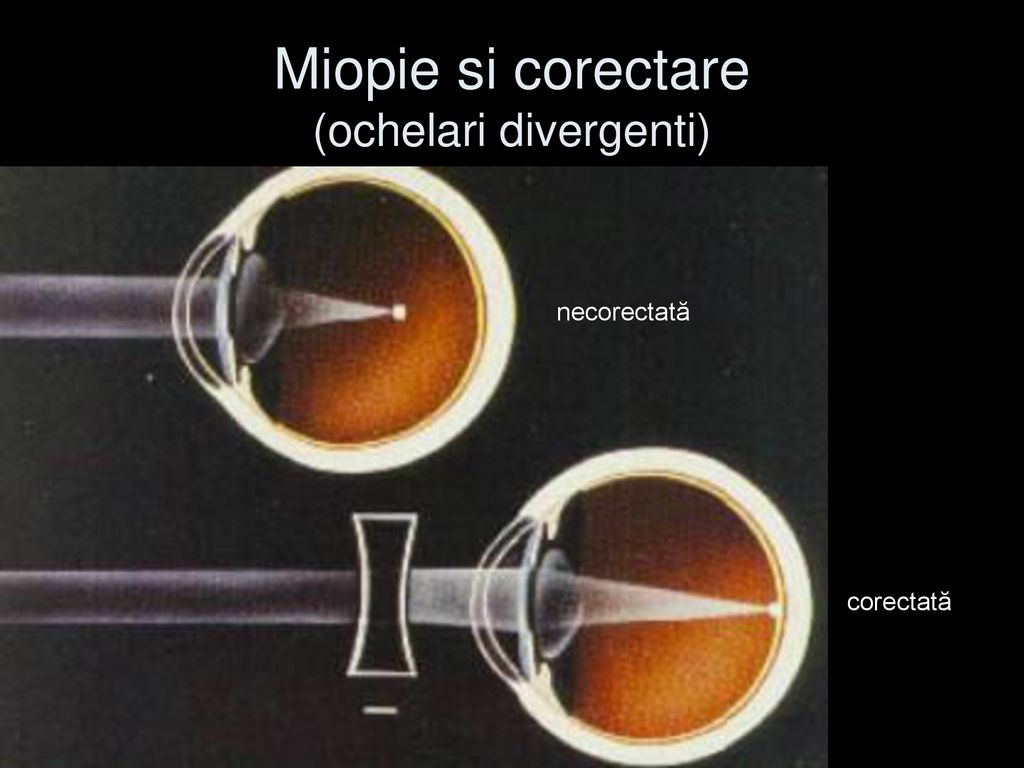 Miopie si corectare (ochelari divergenti)