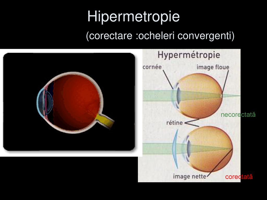 Hipermetropie (corectare :ocheleri convergenti)