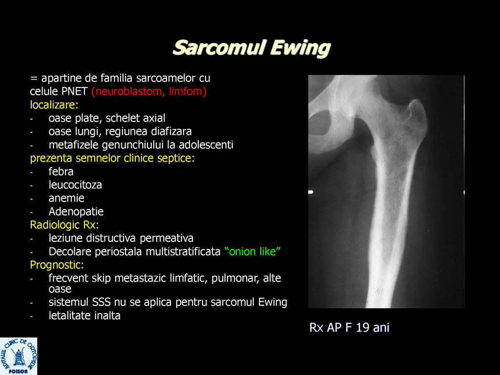 sarcomul genunchiului)