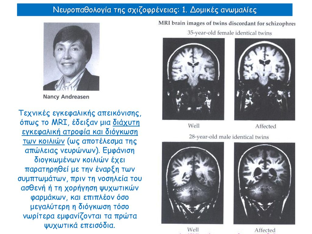 Νευροπαθολογία της σχιζοφρένειας: 1. Δομικές ανωμαλίες