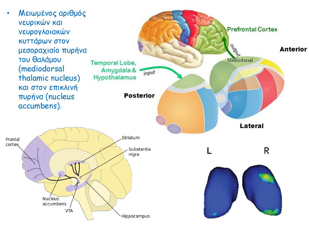 Μειωμένος αριθμός νευρικών και νευρογλοιακών κυττάρων στον μεσοραχιαίο πυρήνα του θαλάμου (mediodorsal thalamic nucleus) και στον επικλινή πυρήνα (nucleus accumbens).